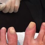 What Happens If You Leave Toenail Fungus Untreated?